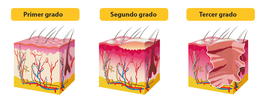 quemaduras