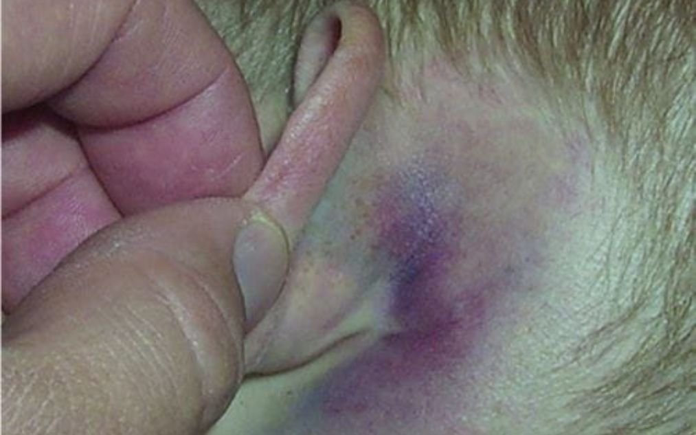 Hematoma en la Apófisis Mastoide