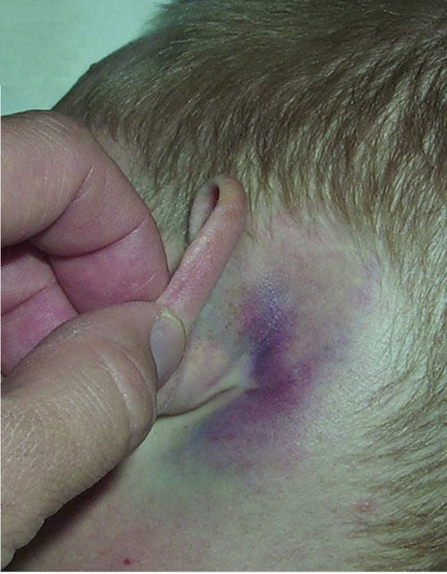 hematoma en la apófisis mastoide